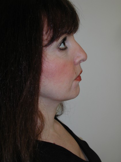 Facelift Before & After Patient #4991