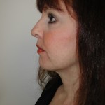 Facelift Before & After Patient #4991