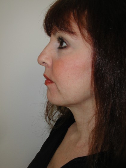 Facelift Before & After Patient #4991