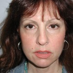 Facelift Before & After Patient #4991