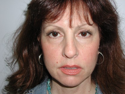 Facelift Before & After Patient #4991