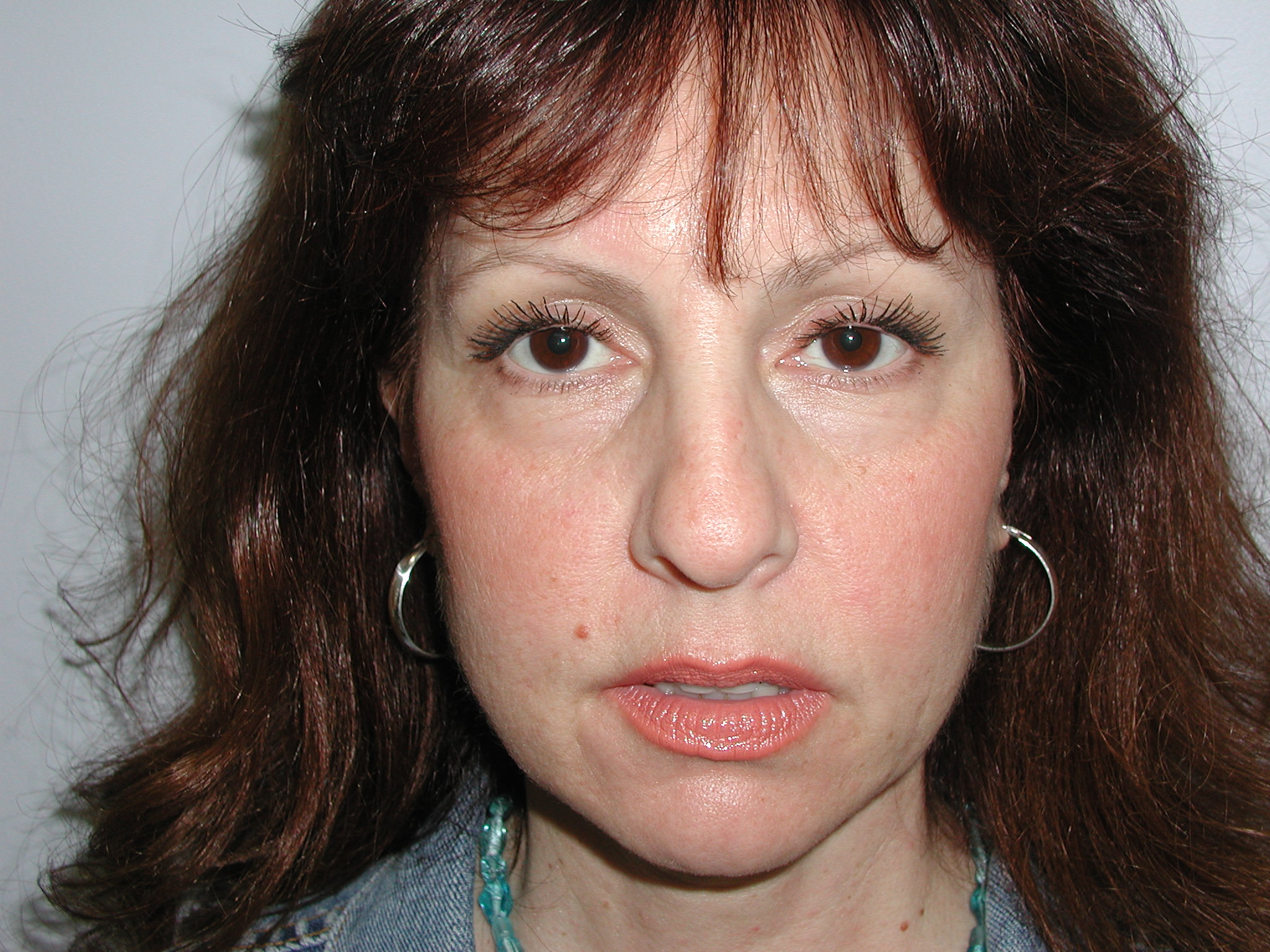 Facelift Before & After Patient #4991