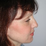 Facelift Before & After Patient #4991