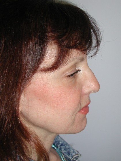 Facelift Before & After Patient #4991