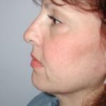 Facelift Before & After Patient #4991