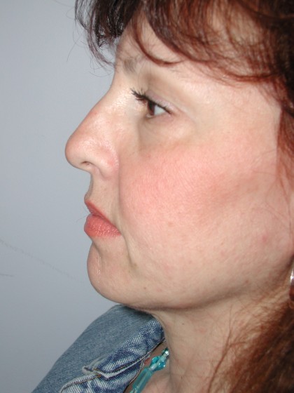 Facelift Before & After Patient #4991