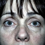 Eyelid Surgery Before & After Patient #4948
