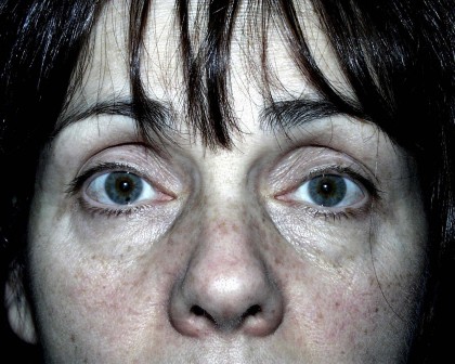 Eyelid Surgery Before & After Patient #4948