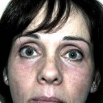 Eyelid Surgery Before & After Patient #4948