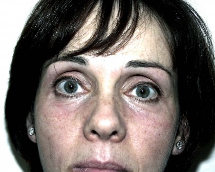 Eyelid Surgery Before & After Patient #4948
