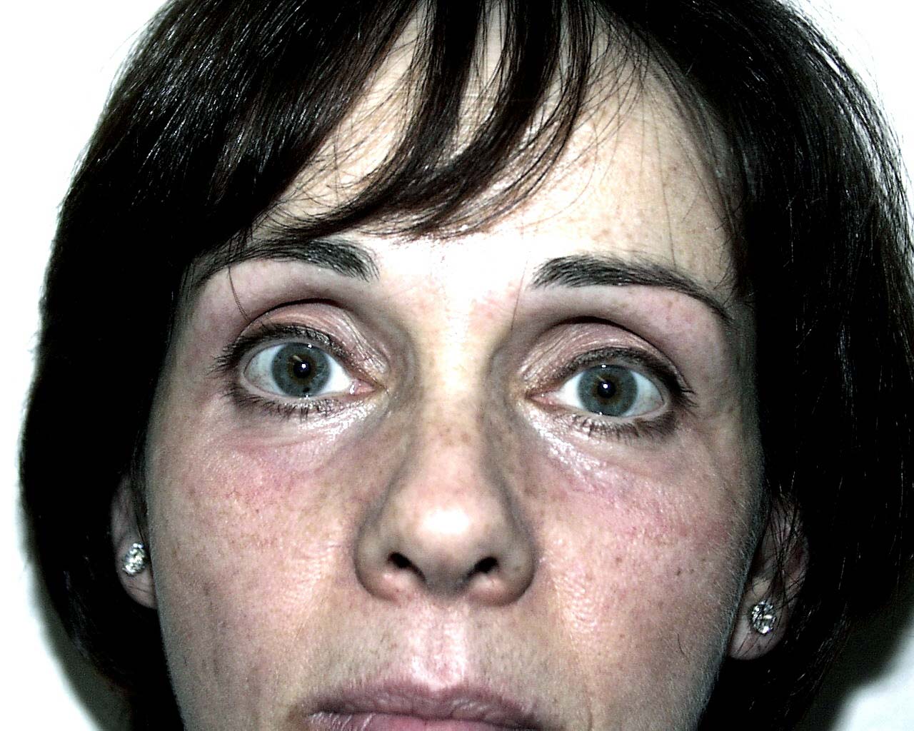 Eyelid Surgery Before & After Patient #4948