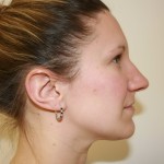 Rhinoplasty Before & After Patient #3994