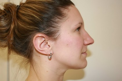 Rhinoplasty Before & After Patient #3994