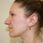 Rhinoplasty Before & After Patient #3994