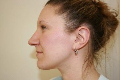 Rhinoplasty Before & After Patient #3994