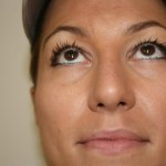 Rhinoplasty Before & After Patient #4998