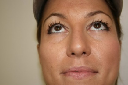 Rhinoplasty Before & After Patient #4998