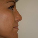 Rhinoplasty Before & After Patient #4998