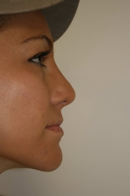 Rhinoplasty Before & After Patient #4998