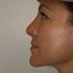 Rhinoplasty Before & After Patient #4998
