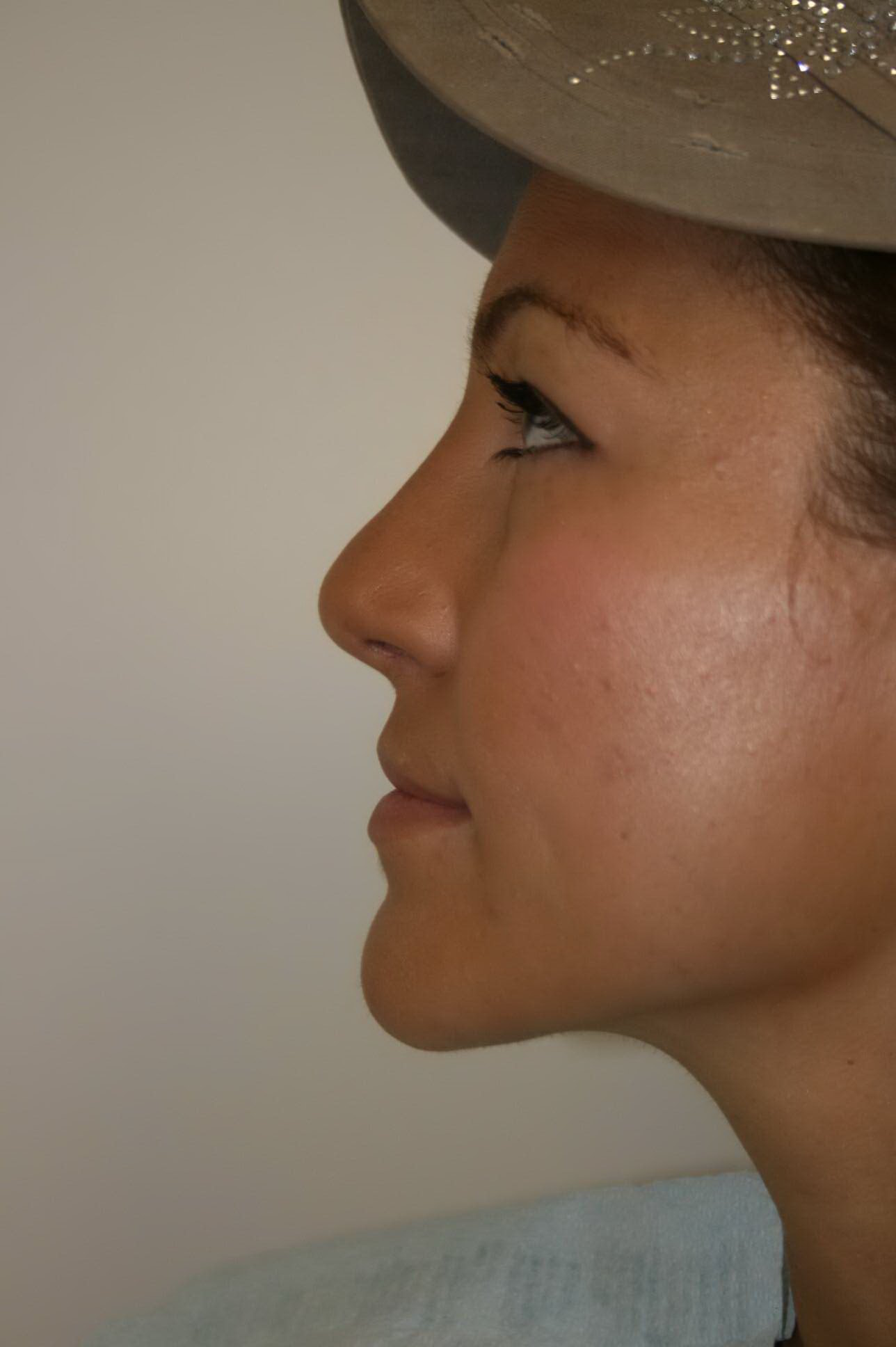 Rhinoplasty Before & After Patient #4998