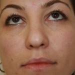 Rhinoplasty Before & After Patient #4998