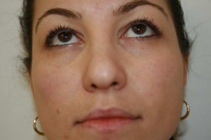 Rhinoplasty Before & After Patient #4998