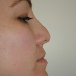 Rhinoplasty Before & After Patient #4998