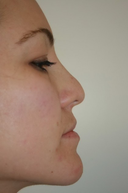 Rhinoplasty Before & After Patient #4998