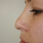 Rhinoplasty Before & After Patient #4998