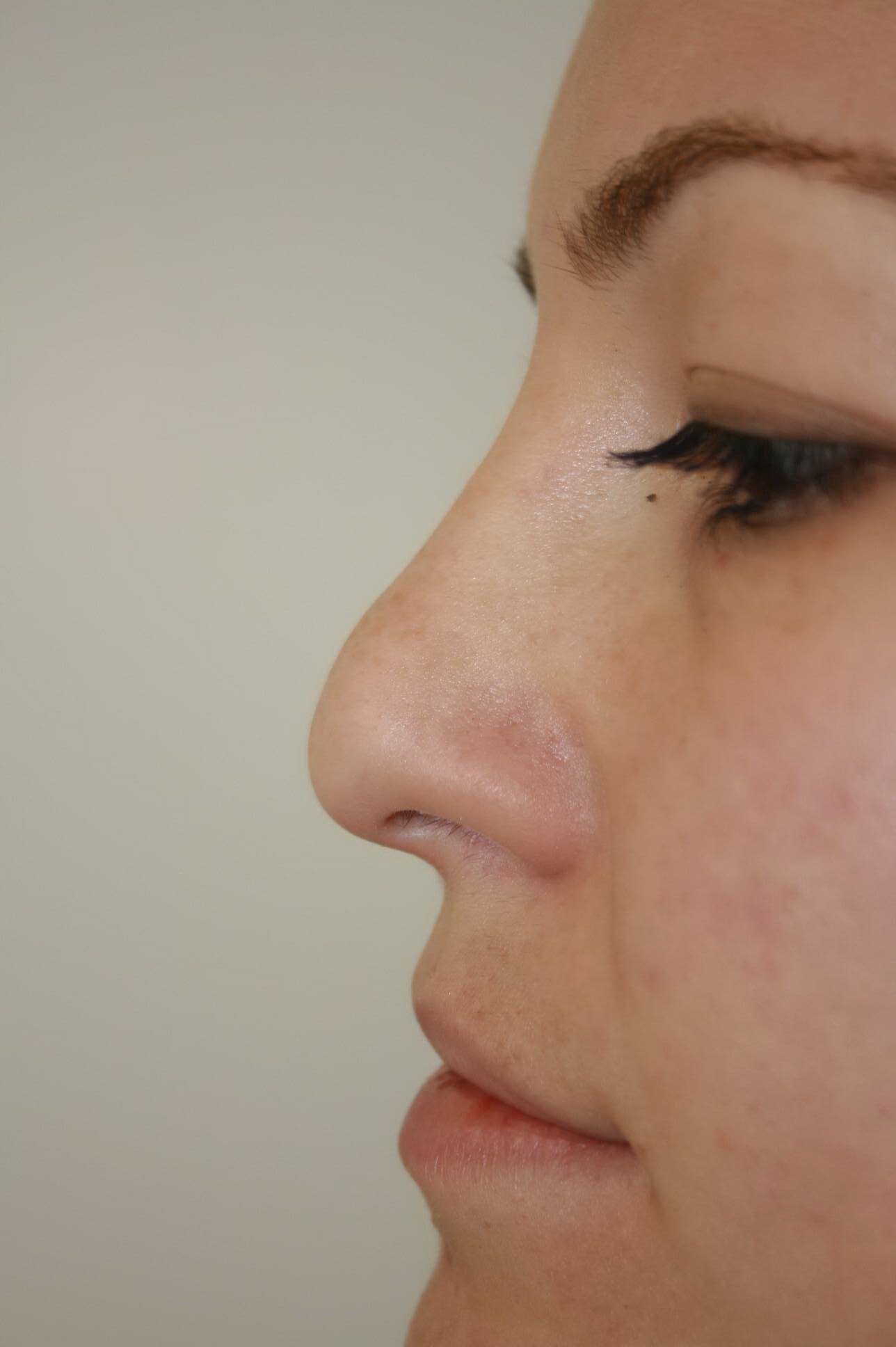 Rhinoplasty Before & After Patient #4998
