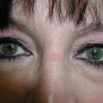 Eyelid Surgery Before & After Patient #4960