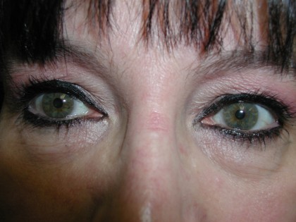 Eyelid Surgery Before & After Patient #4960