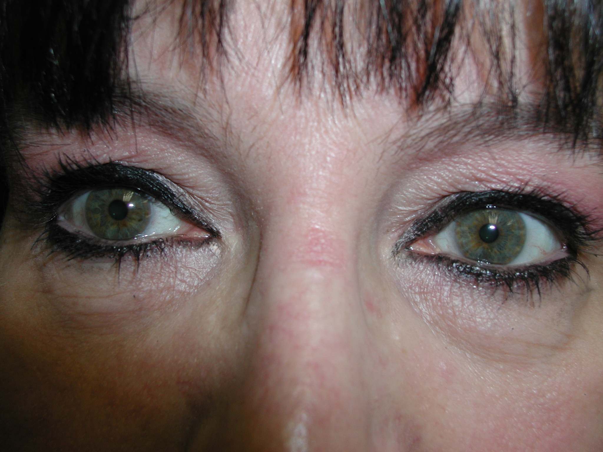 Eyelid Surgery Before & After Patient #4960