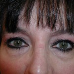 Eyelid Surgery Before & After Patient #4960