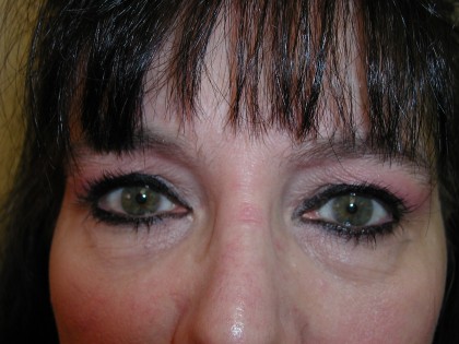 Eyelid Surgery Before & After Patient #4960