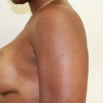 Breast Augmentation Before & After Patient #4951