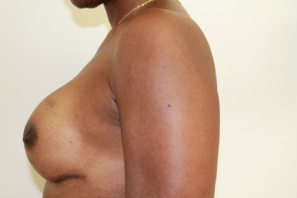 Breast Augmentation Before & After Patient #4951