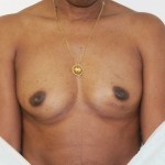 Breast Augmentation Before & After Patient #4951