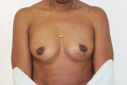 Breast Augmentation Before & After Patient #4951