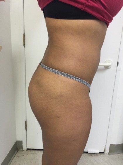 Liposuction Before & After Patient #4931