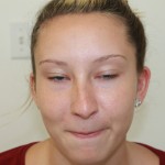 Rhinoplasty Before & After Patient #4975