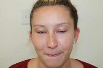 Rhinoplasty Before & After Patient #4975