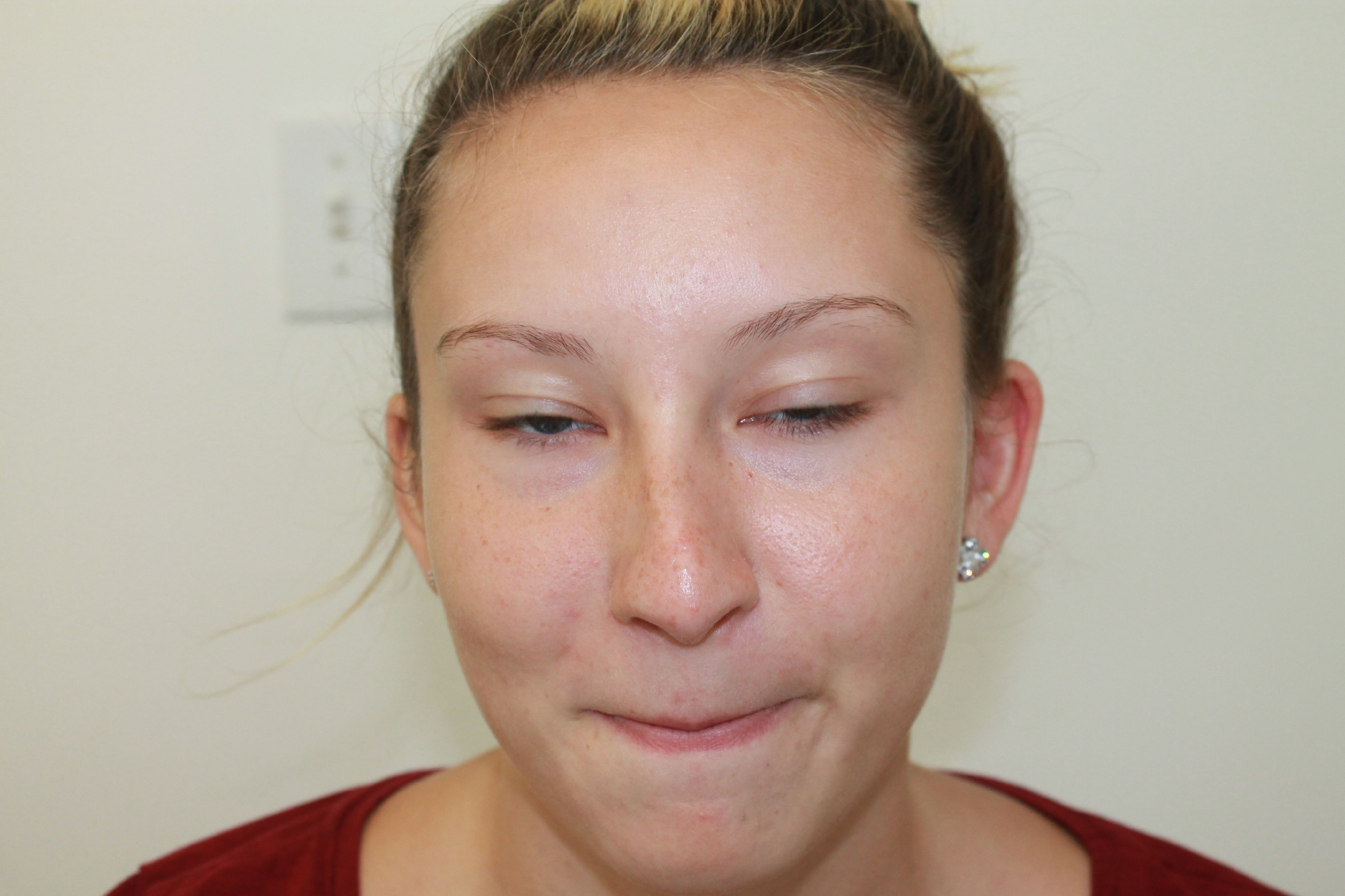 Rhinoplasty Before & After Patient #4975