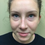 Rhinoplasty Before & After Patient #4975