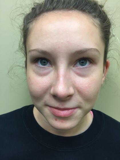 Rhinoplasty Before & After Patient #4975