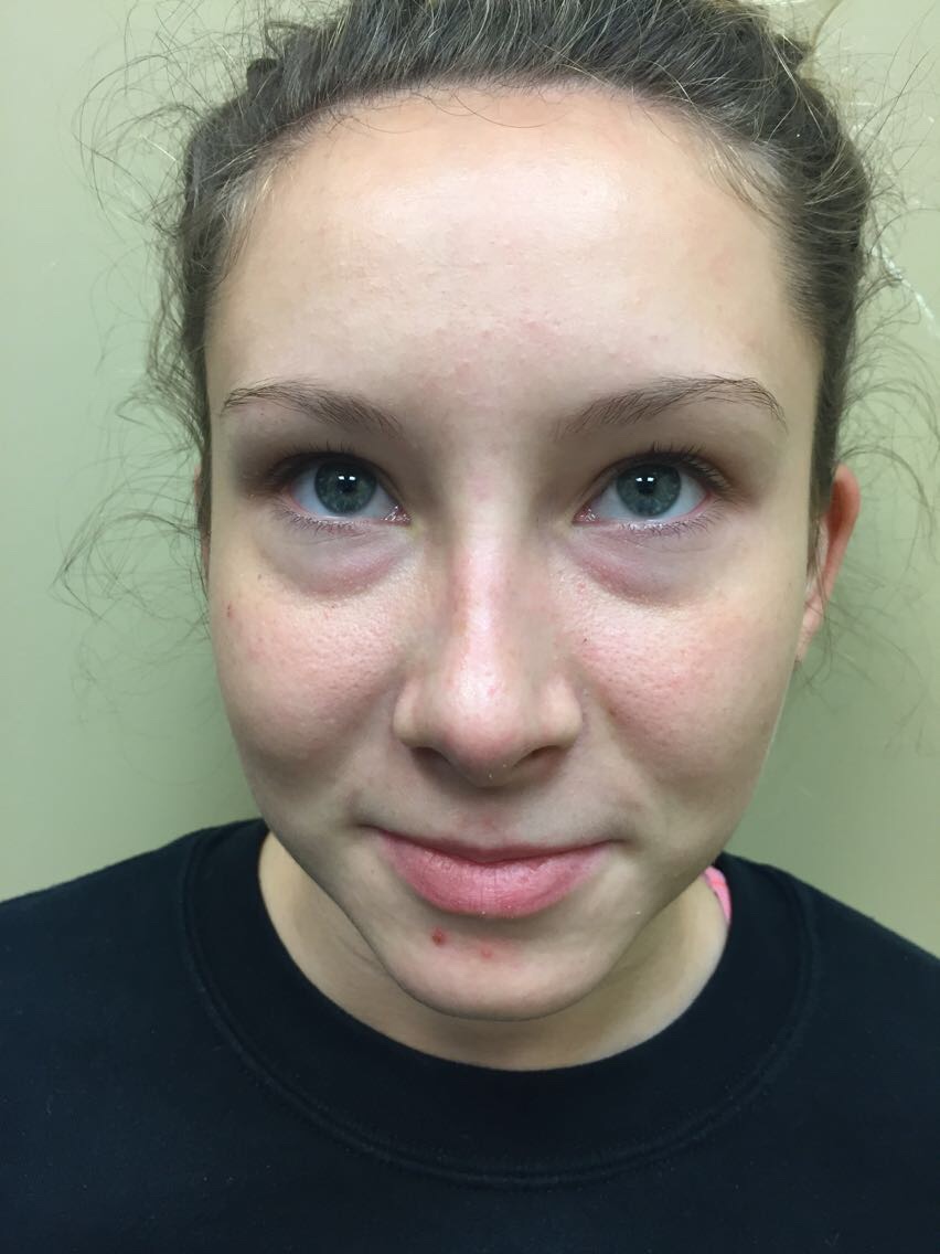 Rhinoplasty Before & After Patient #4975