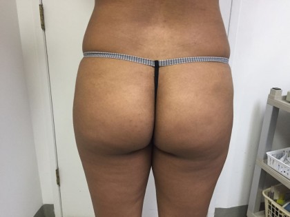 Liposuction Before & After Patient #4931