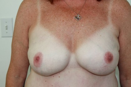 Breast Reconstruction Before & After Patient #4938