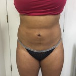 Liposuction Before & After Patient #4931